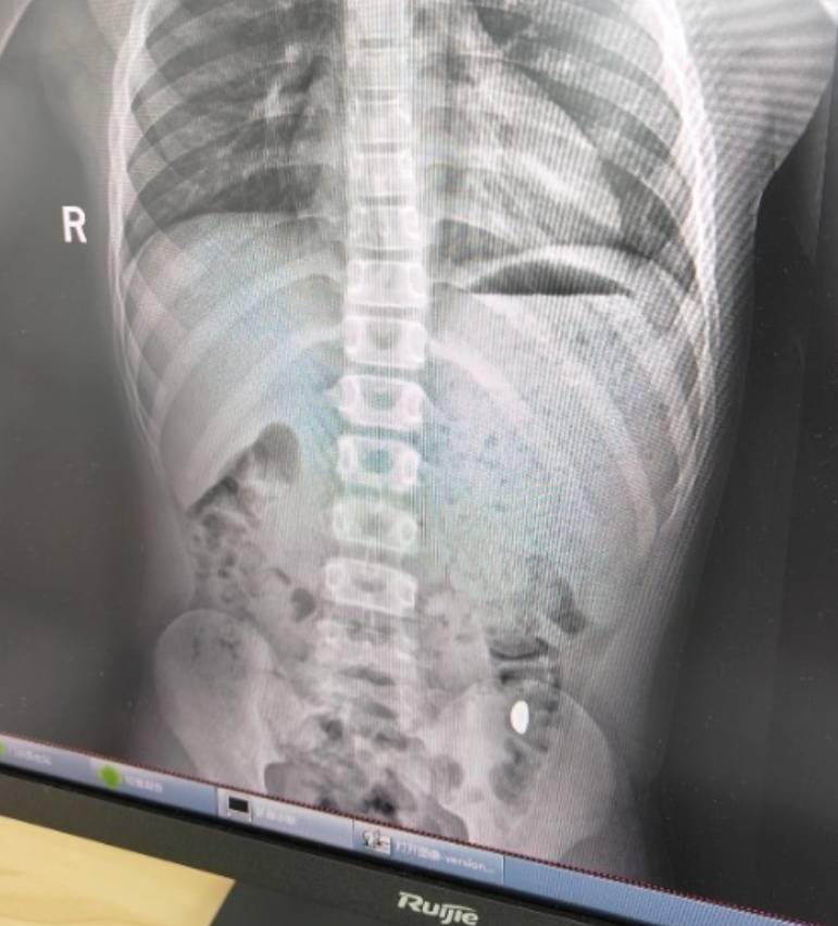 “熊孩子”误吞10克重金豆<strong></p>
<p>宝信软件股票</strong>，妈妈：天天叮嘱他不要在外面拉屎